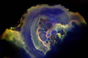 Ductal carcinoma in situ.